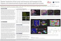 AACR23 海报：肿瘤和免疫细胞胰腺导管腺癌的空间解析 (200px)