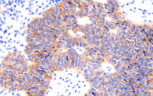 使用 Claudin-6 对人卵巢浆液性乳头状癌组织进行免疫组织化学分析