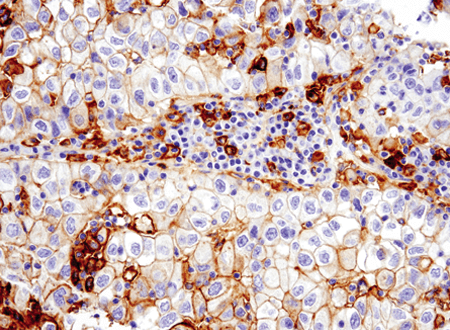 使用 PD-L1 对非小细胞肺癌组织进行免疫组织化学分析