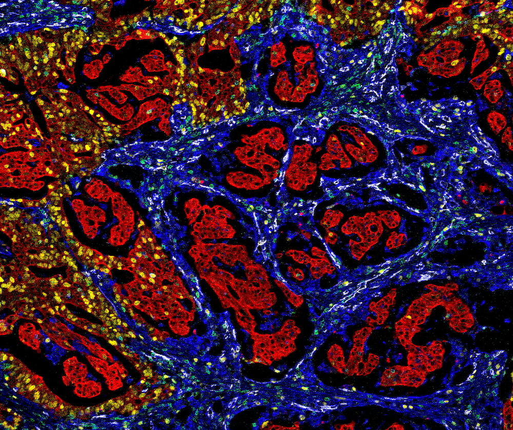 结直肠癌组织的质谱流式细胞图