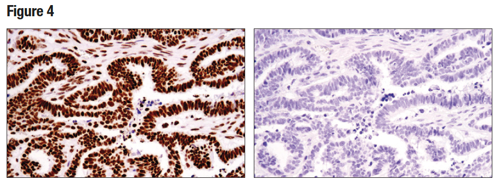 使用 Tri-Methyl-Histone H3 (Lys36) (D5A7) 对石蜡包埋的人卵巢浆液性乳头状癌细胞进行免疫组织化学分析。