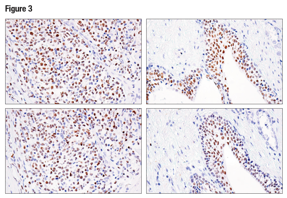 使用 Helios (E4L5U)（上图）或 Helios 抗体（下图）对石蜡包埋的人 B 细胞非霍奇金氏淋巴瘤（左图）或前列腺癌（右图）细胞进行免疫组织化学分析。