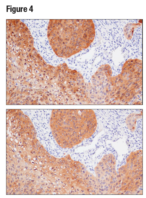 使用 MAGE-A4 (E7O1U)（上图）或 MAGE-A4 Antibody（下图）对石蜡包埋的人鳞状细胞肺癌进行免疫组织化学分析