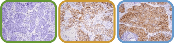 使用 DDL3 在 IHC 中分析了三个样本