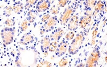 使用 N-Cadherin Antibody（EMT 标记物）对胃癌组织进行免疫组织化学分析
