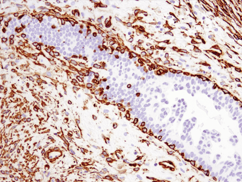 使用 α-Smooth Muscle Actin Antibody（一种上皮-间质细胞转换标记物）对乳腺癌组织进行免疫组织化学分析