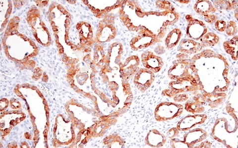 使用 EMT 标记物 Occludin Antibody 对卵巢透明细胞癌组织进行免疫组织化学分析