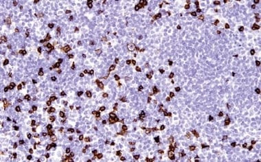 85336_使用 CD8 抗体对细胞毒性 T 细胞进行 IHC 分析