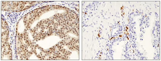 ERG 前列腺癌 IHC 分析_裁剪