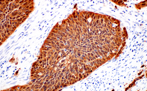 使用 p16 INK4A 对人子宫颈鳞状细胞癌阻止进行免疫组织化学分析